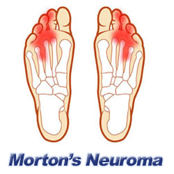 How is Morton's neuroma treated?